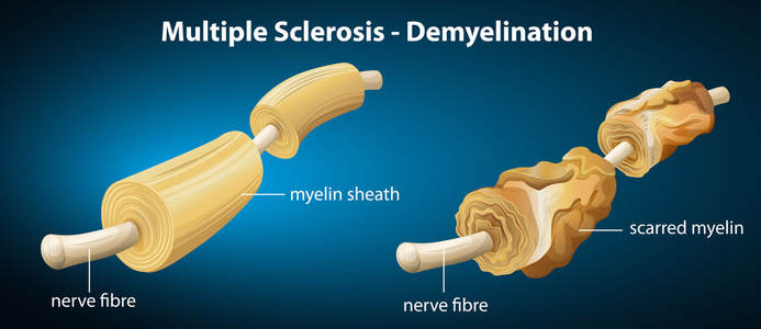 myelin sheath - multiple sclerosis Picture