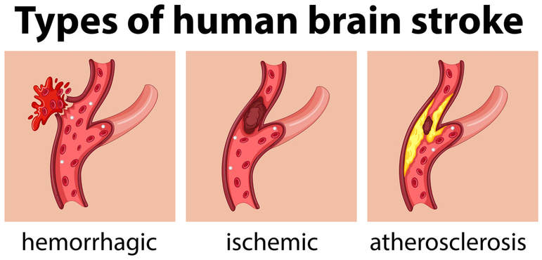 TYPES OF HUMAN BRAIN STROKE Picture